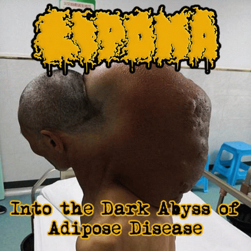 Lipoma : Into the Dark Abyss of Adipose Disease